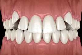 Crossbite Teeth