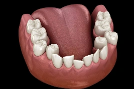 Crowded Teeth