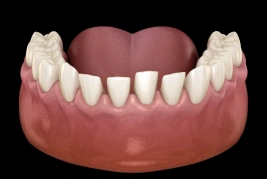 Gapped Teeth