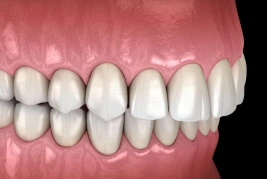 Overbite Teeth