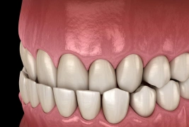 Underbite Teeth