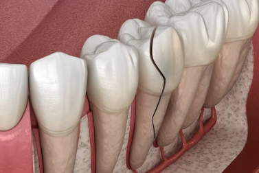 Chipped or Cracked Teeth