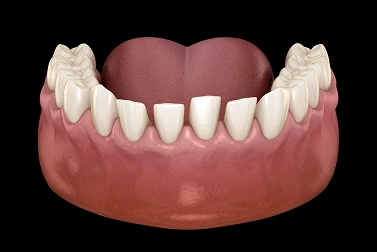Small Gaps Between Teeth