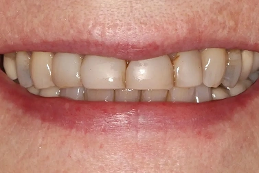 Stained or Discolored Teeth