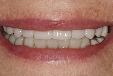 Teeth That Appear Too Short or Too Small