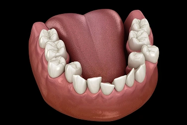 Uneven or Irregularly Shaped Teeth