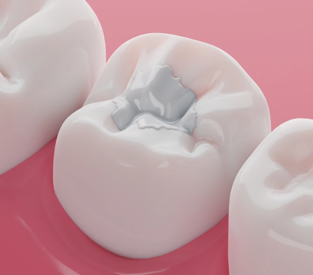 Tooth with a dental filling restoring a cavity and protecting oral health