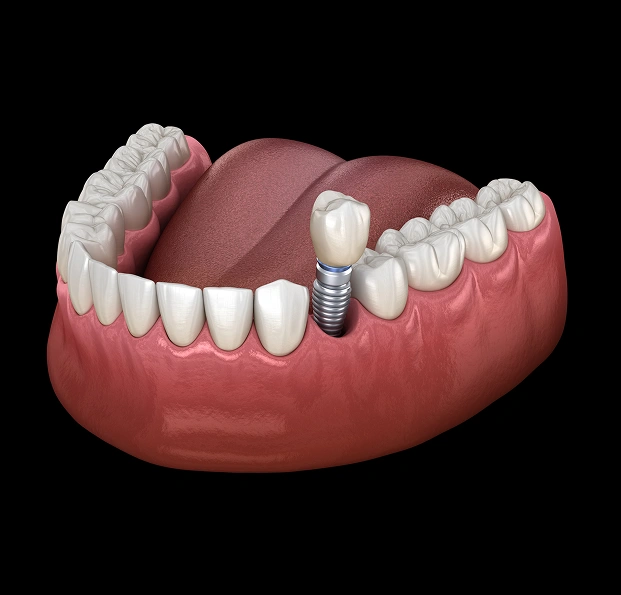 Dental implant restoration replacing a missing tooth with a natural-looking result